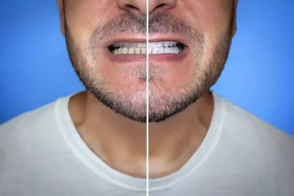 before-after.webp