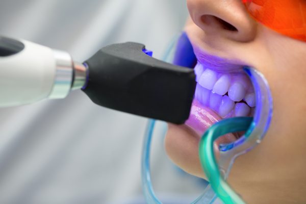 clareamento-dental